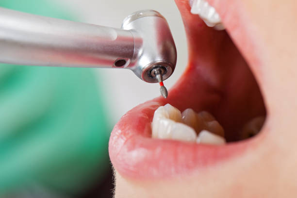 Best Broken or Chipped Tooth Repair in Minot Af, ND